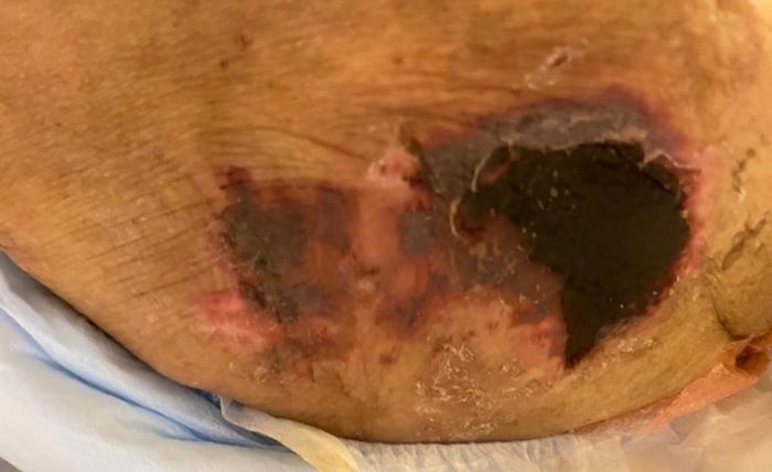 Understanding Kennedy Terminal Ulcers, Other End-of-Life Skin Changes, and Unavoidable Skin Injuries and Ulcers