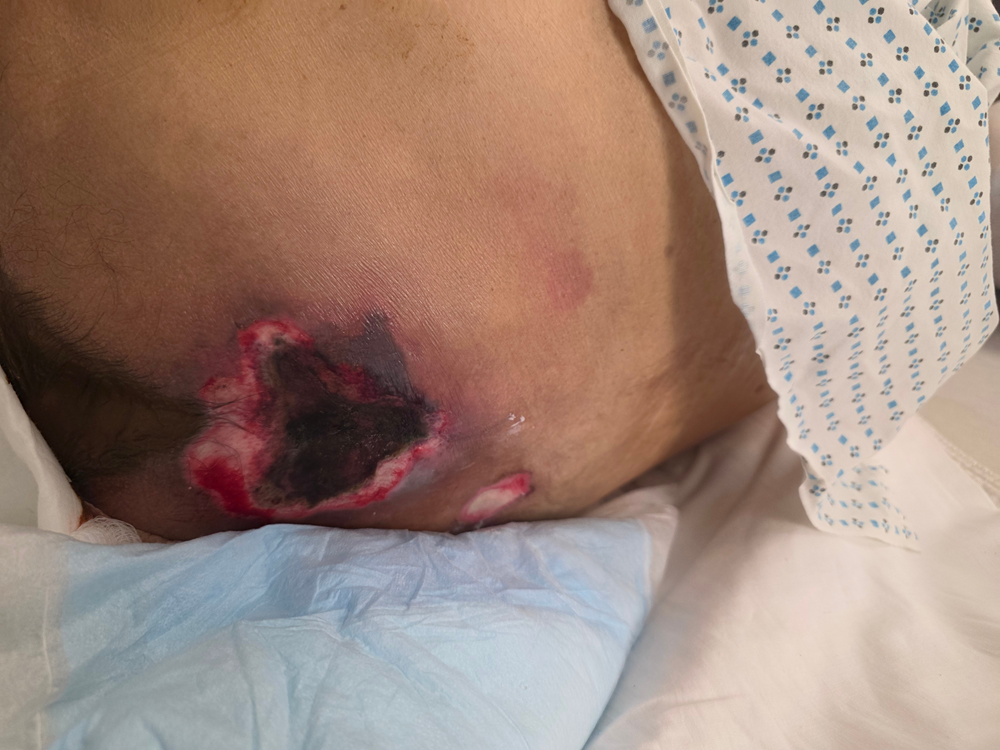 Kennedy Terminal Ulcer (KTUs):